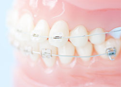 理想の歯並びを実現するため、抜歯やワイヤー矯正を併用します