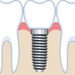 天然歯のような機能回復ができる「インプラント」とはどんなもの？
