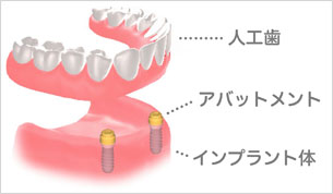 オーバーデンチャー
