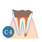 虫歯の進行C4