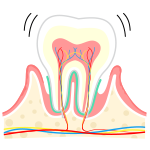 歯周病（中度）
